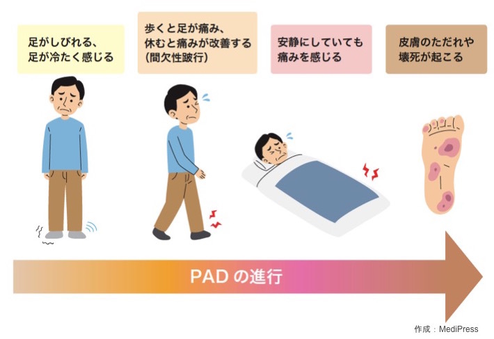 末梢動脈疾患による皮膚の変化