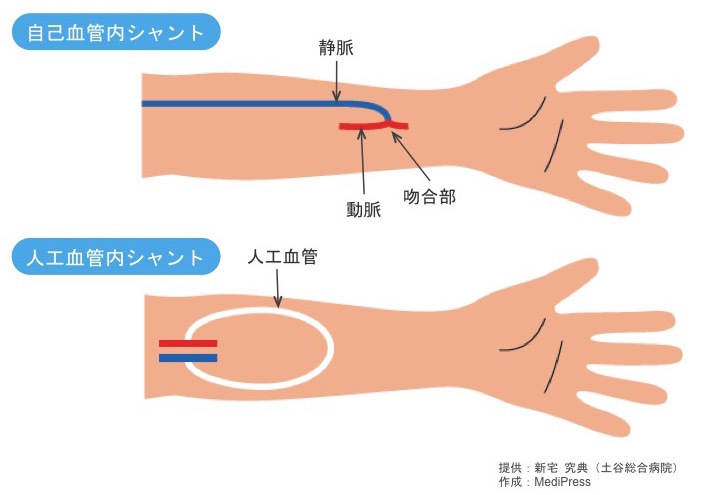 吻合術と人工肛門形成術
