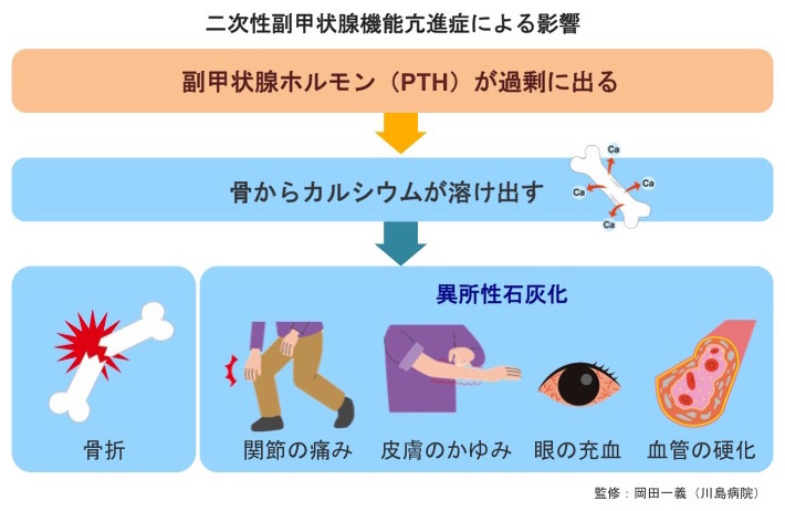 二次性凝固亢進状態の人々の見通しはどうなりますか?